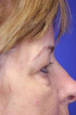 Eyelid Lift Case 3935 Before Photo Eyelid Lift