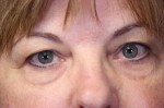 Eyelid Lift