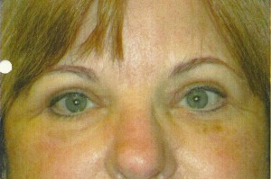 Eyelid Lift Case 3935 After Photo Eyelid Lift