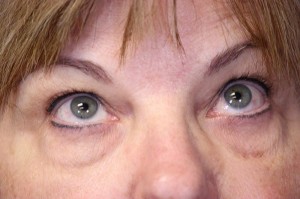 Eyelid Lift Case 3935 Before Photo Eyelid Lift