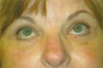 Eyelid Lift