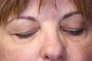 Eyelid Lift Case 3935 Before Photo Eyelid Lift