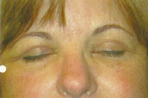 Eyelid Lift Case 3935 After Photo Eyelid Lift