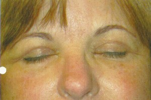 Eyelid Lift