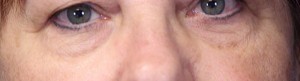 Eyelid Lift Case 3935 Before Photo Eyelid Lift