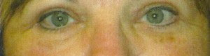 Eyelid Lift Case 3935 After Photo Eyelid Lift