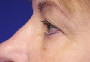 Eyelid Lift Case 3935 Before Photo Eyelid Lift