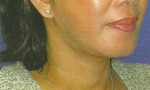 Chin Implant