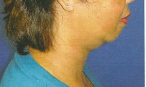 Chin Implant