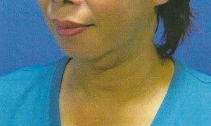 Chin Implant