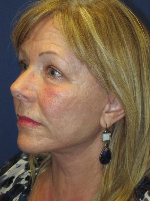 FACEology Lift / Neck Lift Case 3963 After Photo FACEology Lift / Neck Lift