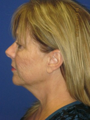 FACEology Lift / Neck Lift Case 3963 Before Photo FACEology Lift / Neck Lift