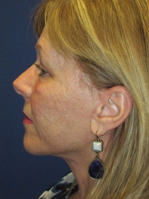 FACEology Lift / Neck Lift Case 3963 After Photo FACEology Lift / Neck Lift