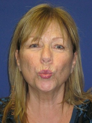 FACEology Lift / Neck Lift Case 3963 Before Photo FACEology Lift / Neck Lift