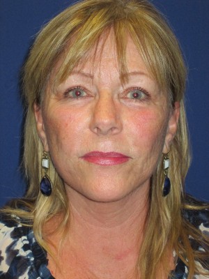 FACEology Lift / Neck Lift Case 3963 After Photo FACEology Lift / Neck Lift