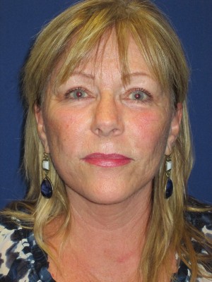 FACEology Lift / Neck Lift