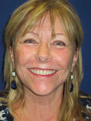 FACEology Lift / Neck Lift Case 3963 After Photo FACEology Lift / Neck Lift