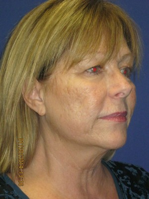 FACEology Lift / Neck Lift Case 3963 Before Photo FACEology Lift / Neck Lift