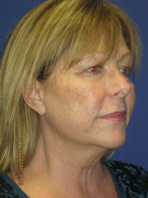 FACEology Lift / Neck Lift