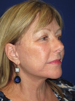 FACEology Lift / Neck Lift Case 3963 After Photo FACEology Lift / Neck Lift