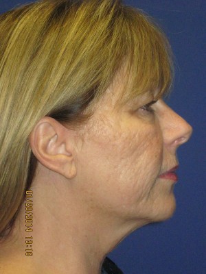 FACEology Lift / Neck Lift Case 3963 Before Photo FACEology Lift / Neck Lift