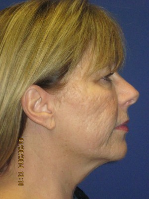 FACEology Lift / Neck Lift