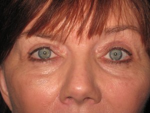 FACEology Lift / Neck Lift Case 3979 After Photo FACEology Lift / Neck Lift