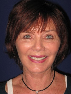 FACEology Lift / Neck Lift Case 3979 After Photo FACEology Lift / Neck Lift