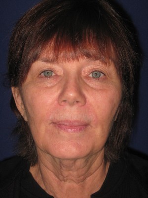 FACEology Lift / Neck Lift Case 3979 Before Photo FACEology Lift / Neck Lift