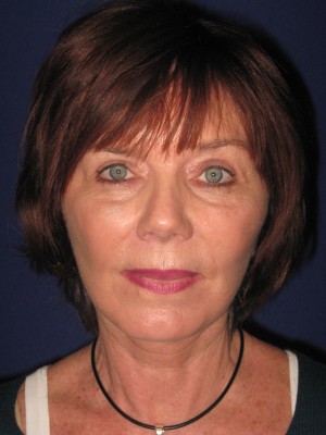 FACEology Lift / Neck Lift Case 3979 After Photo FACEology Lift / Neck Lift