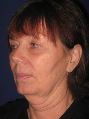 FACEology Lift / Neck Lift Case 3979 Before Photo FACEology Lift / Neck Lift