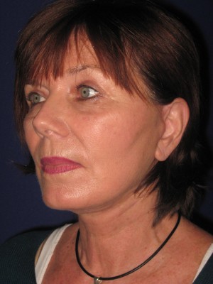 FACEology Lift / Neck Lift Case 3979 After Photo FACEology Lift / Neck Lift