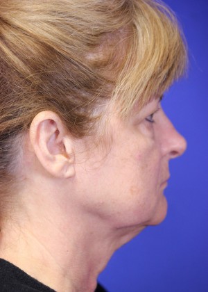 FACEology Lift / Neck Lift Case 3989 Before Photo FACEology Lift / Neck Lift