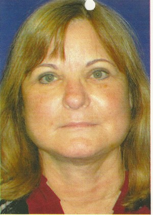 FACEology Lift / Neck Lift Case 3989 After Photo FACEology Lift / Neck Lift