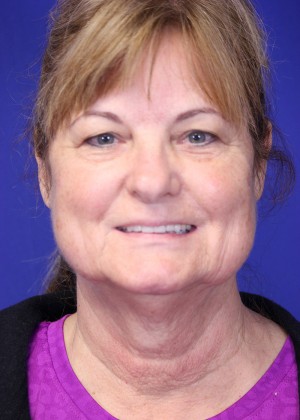 FACEology Lift / Neck Lift Case 3989 Before Photo FACEology Lift / Neck Lift