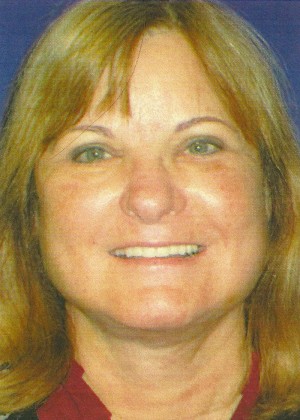 FACEology Lift / Neck Lift Case 3989 After Photo FACEology Lift / Neck Lift