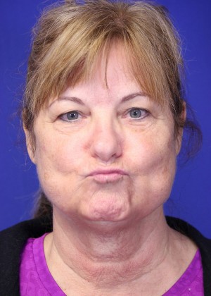 FACEology Lift / Neck Lift Case 3989 Before Photo FACEology Lift / Neck Lift