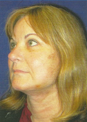 FACEology Lift / Neck Lift Case 3989 After Photo FACEology Lift / Neck Lift