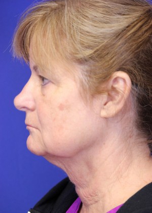 FACEology Lift / Neck Lift Case 3989 Before Photo FACEology Lift / Neck Lift