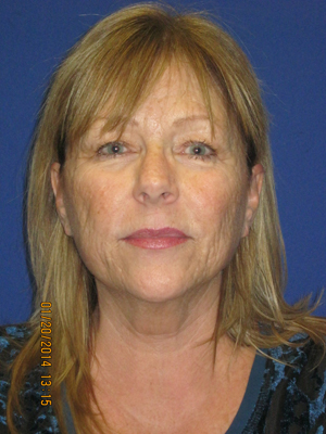 FACEology Lift / Neck Lift Case 3963 Before Photo FACEology Lift / Neck Lift