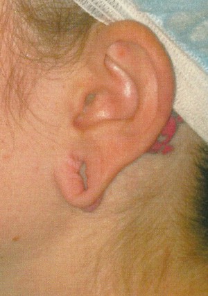 Ear Surgery Case 4035 Before Photo Ear Surgery