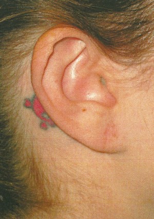 Ear Surgery Case 4035 After Photo Ear Surgery