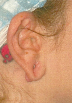 Ear Surgery Case 4035 Before Photo Ear Surgery
