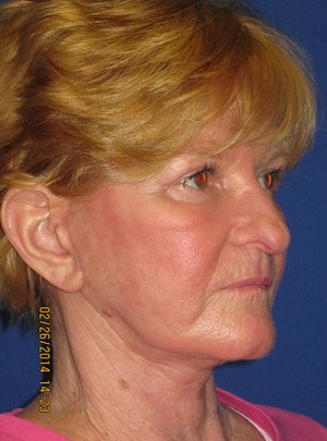 Laser Resurfacing Case 4060 After Photo Laser Resurfacing