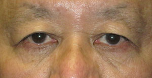 Eyelid Lift Case 4139 Before Photo Eyelid Lift