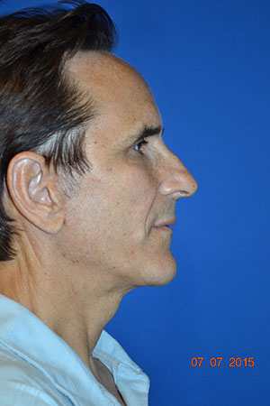 FACEology Lift / Neck Lift