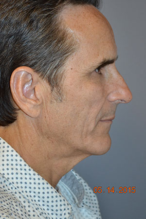 FACEology Lift / Neck Lift