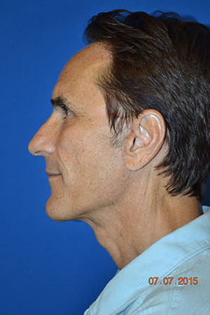 FACEology Lift / Neck Lift