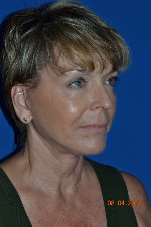 FACEology Lift / Neck Lift Case 4170 After Photo FACEology Lift / Neck Lift