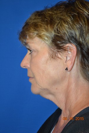 FACEology Lift / Neck Lift Case 4170 Before Photo FACEology Lift / Neck Lift